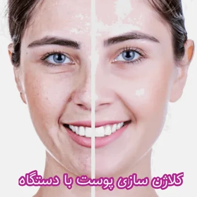 معرفی بهترین روش های کلاژن‌سازی پوست صورت با دستگاه